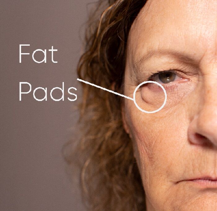 Zephyrhills Fat Pad Removal - Florida Face and Body